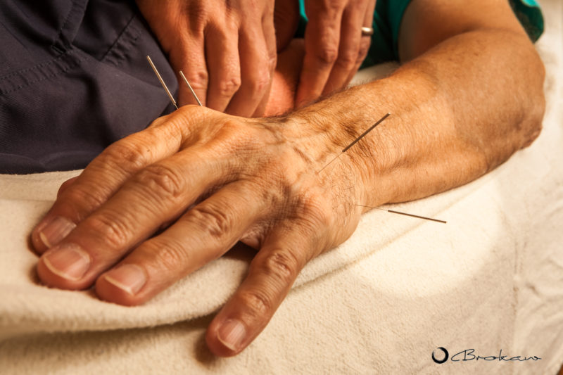 BUSINESS PHOTOS: ACUPUNCTURE